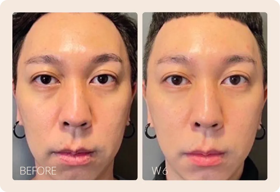 本案例由 巧絲顏 SALIENT 提供，為實際療程分享，效果呈現因人而異，需經醫師專業評估。